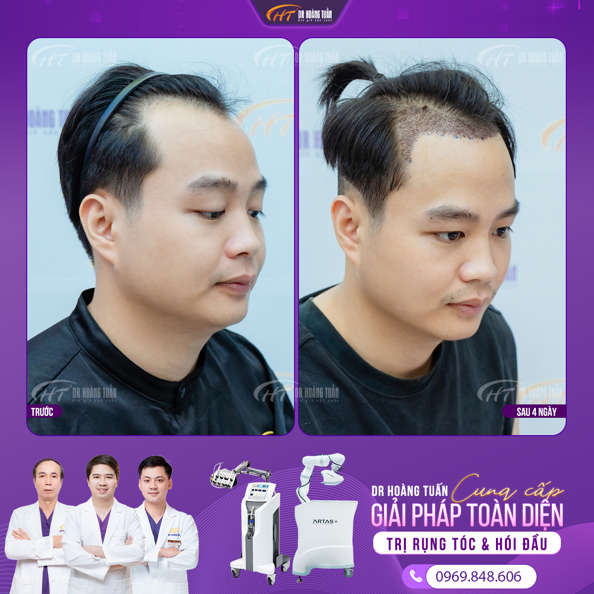 Sau khi cấy tóc nên kiêng ăn gì